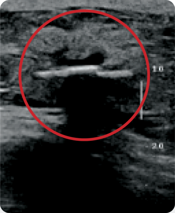 Ultrasound