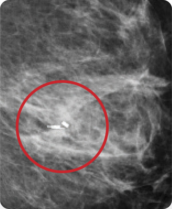 Mammogram