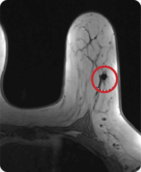 MRI