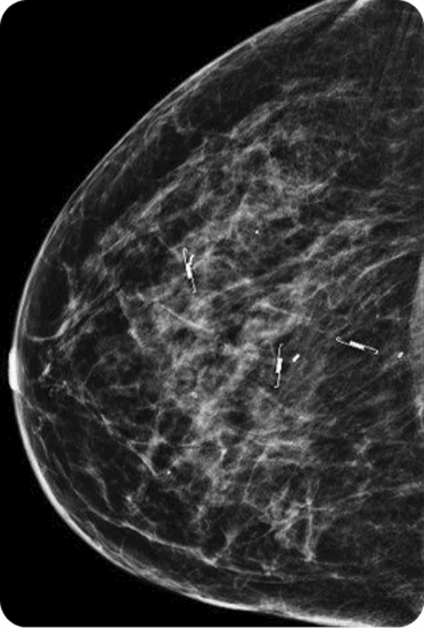 Mammography